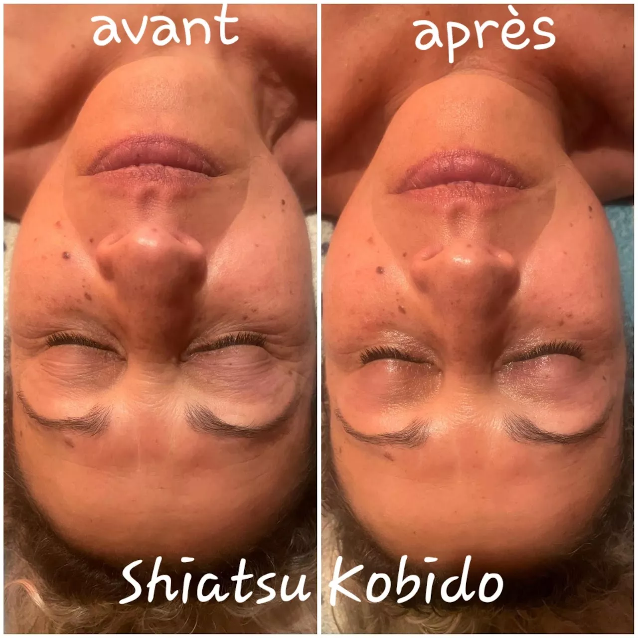 Avant et après une séance de Kobido – résultats visibles sur le visage